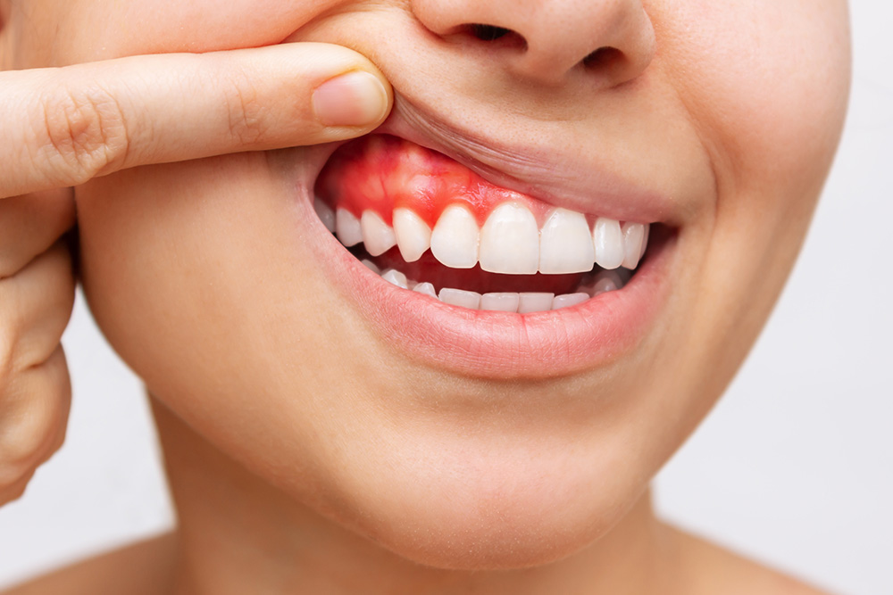 Gum Disease: Causes, Symptoms, and Effective Treatment in Woodland Hills