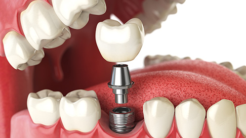 Dental Implants – What You Need to Know