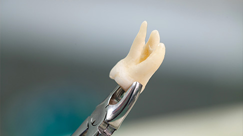 When It’s Time to Let Go: Understanding the Need for Tooth Extractions