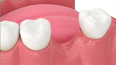 What Happens to Your Jaw After a Tooth Is Pulled? Let’s Talk About Bone Loss
