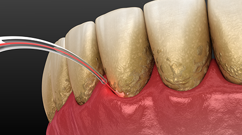 Laser Teeth Cleaning – The Future of Oral Health Care