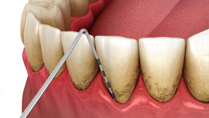 rendering of dental pool scraping buildup off teeth