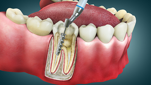 Understanding Root Canals: Causes, Procedure, and Pain Management