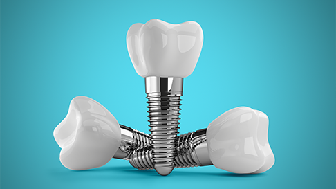 Dental Implant Treatment Options – What You Need to Know